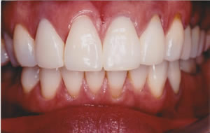 前歯の治療後